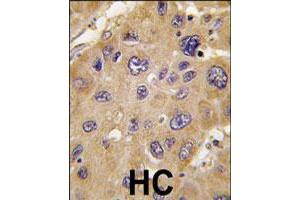 Formalin-fixed and paraffin-embedded human hepatocellular carcinoma reacted with ALDH6A1 polyclonal antibody  , which was peroxidase-conjugated to the secondary antibody, followed by DAB staining. (ALDH6A1 anticorps  (C-Term))