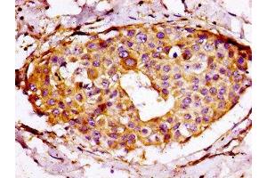 IHC image of ABIN7142571 diluted at 1:100 and staining in paraffin-embedded human breast cancer performed on a Leica BondTM system.