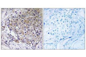Immunohistochemistry analysis of paraffin-embedded human breast carcinoma tissue, using WASF3antibody. (WASF3 anticorps  (Internal Region))