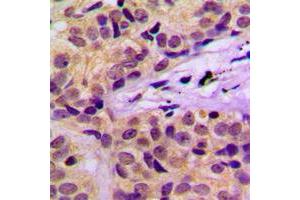 Immunohistochemical analysis of c-CBL (pY674) staining in human cervical cancer formalin fixed paraffin embedded tissue section. (CBL anticorps  (pTyr674))