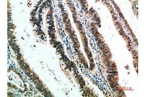 Immunohistochemical analysis of paraffin-embedded human-colon-cancer, antibody was diluted at 1:200
