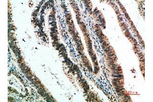 Immunohistochemical analysis of paraffin-embedded human-colon-cancer, antibody was diluted at 1:200 (CLEC4A anticorps  (AA 161-210))