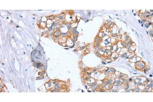 Immunohistochemistry of paraffin-embedded Human breast cancer using PTP4A2 Polyclonal Antibody at dilution of 1:30 (PTP4A2 anticorps)