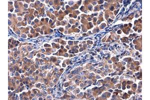 IHC-P Image Calpastatin antibody detects Calpastatin protein at cytoplasm in human lung cancer by immunohistochemical analysis. (Calpastatin anticorps)