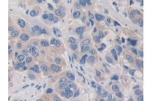 Detection of PDHX in Human Breast cancer Tissue using Polyclonal Antibody to Pyruvate Dehydrogenase Complex Component X (PDHX) (PDHX anticorps  (AA 220-468))