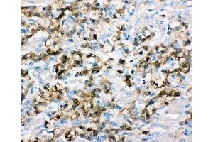 IHC-P: ALDH3A1 antibody testing of human gastric cancer tissue (ALDH3A1 anticorps  (C-Term))