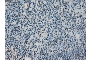 Immunohistochemical staining of paraffin-embedded lymphoma tissue using anti-PRKYmouse monoclonal antibody. (PRKY anticorps)