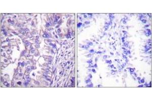 Immunohistochemistry analysis of paraffin-embedded human lung carcinoma tissue, using GAD1/2 Antibody. (GAD65+GAD67 (AA 545-594) anticorps)