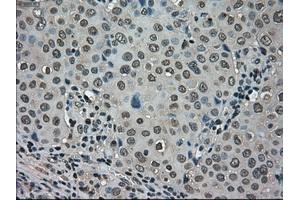 Immunohistochemical staining of paraffin-embedded Carcinoma of kidney tissue using anti-LDHAmouse monoclonal antibody. (Lactate Dehydrogenase A anticorps)