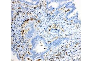 IHC-P: TRPC6 antibody testing of human intestinal cancer tissue (TRPC6 anticorps  (Middle Region))