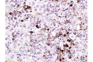 Formalin-fixed and paraffin embedded mouse melanoma labeled with Anti- MITF Polyclonal Antibody, Unconjugated  at 1:200 followed by conjugation to the secondary antibody and DAB staining