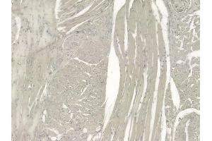 ABIN6257159 and ABIN6275121 at 1/100 staining human tongue carcinoma by IHC-P.