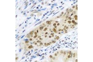 Immunohistochemical analysis of Cullin 4A staining in human colon cancer formalin fixed paraffin embedded tissue section. (Cullin 4A anticorps)