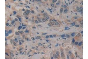 Detection of KLK10 in Human Breast cancer Tissue using Polyclonal Antibody to Kallikrein 10 (KLK10)
