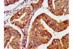 IHC image of ABIN7166879 diluted at 1:600 and staining in paraffin-embedded human endometrial cancer performed on a Leica BondTM system.