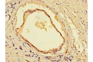 Immunohistochemistry of paraffin-embedded human prostate cancer using ABIN7160974 at dilution of 1:100 (CYB5R1 anticorps  (AA 29-305))