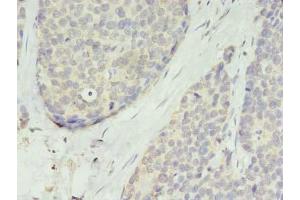 Immunohistochemistry of paraffin-embedded human gastric cancer using ABIN7173225 at dilution of 1:100 (TMEM45A anticorps  (AA 171-217))