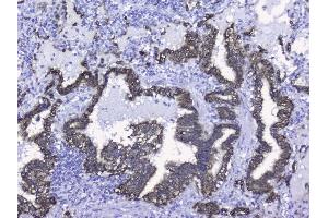 IHC analysis of Cytokeratin 19 using anti-Cytokeratin 19 antibody (ABIN3043288).