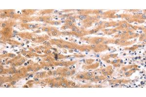 Immunohistochemistry of paraffin-embedded Human liver cancer tissue using HCRTR1 Polyclonal Antibody at dilution 1:70 (HCRTR1 anticorps)