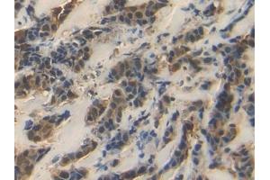 Detection of HSPA1A in Human Breast cancer Tissue using Polyclonal Antibody to Heat Shock 70 kDa Protein 1A (HSPA1A)