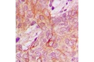Immunohistochemical analysis of PPM1K staining in human breast cancer formalin fixed paraffin embedded tissue section.