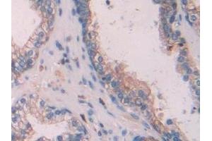 Detection of KRT6C in Human Prostate Tissue using Polyclonal Antibody to Keratin 6C (KRT6C)