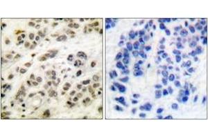 Immunohistochemistry analysis of paraffin-embedded human breast carcinoma tissue, using MYC (Ab-62) Antibody.