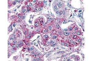 Anti-GRM8 / MGLUR8 antibody IHC of human Pancreas, Carcinoma. (GRM8 anticorps  (N-Term))