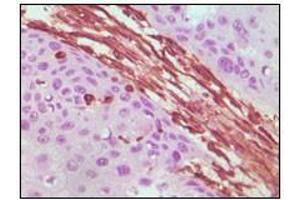 Immunohistochemical analysis of paraffin-embedded human lung carcinoma tissue, showing cytoplasmic localization using Vimentin antibody with DAB staining. (Vimentin anticorps)