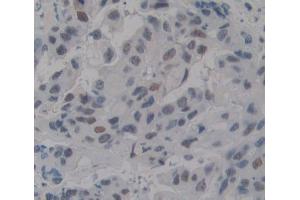 IHC-P analysis of breast tissue, with DAB staining. (TDP1 anticorps  (AA 4-215))