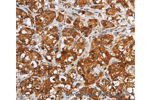 Immunohistochemistry of Human liver cancer using GGCX Polyclonal Antibody at dilution of 1:60