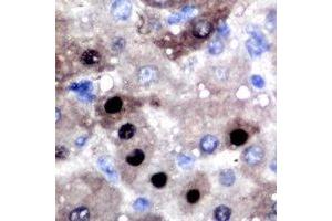 Immunohistochemical analysis of BCL11A staining in human liver cancer formalin fixed paraffin embedded tissue section. (BCL11A anticorps)