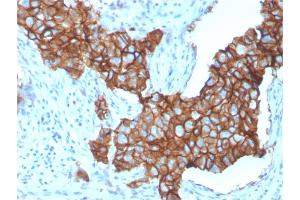 Formalin-fixed, paraffin-embedded human Breast Carcinoma stained with HER-2 Monospecific Mouse Monoclonal Antibody (ERBB2/3257). (ErbB2/Her2 anticorps  (AA 311-462))