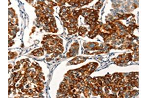 The image on the left is immunohistochemistry of paraffin-embedded Human breast cancer tissue using ABIN7189718(AGO4 Antibody) at dilution 1/25, on the right is treated with synthetic peptide. (AGO4 anticorps)