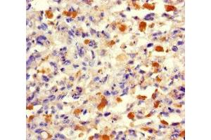 Immunohistochemistry of paraffin-embedded human melanoma using ABIN7173512 at dilution of 1:100 (TRMT112 anticorps  (AA 1-125))