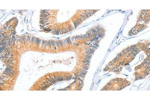 Immunohistochemistry of paraffin-embedded Human colon cancer using ACY3 Polyclonal Antibody at dilution of 1:35 (Aminoacylase 3 anticorps)