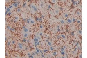Detection of CIDEC in Human Glioma Tissue using Polyclonal Antibody to Cell Death Inducing DFFA Like Effector C (CIDEC)