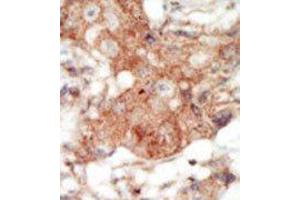 Formalin-fixed and paraffin-embedded human cancer tissue reacted with the primary antibody, which was peroxidase-conjugated to the secondary antibody, followed by DAB staining.