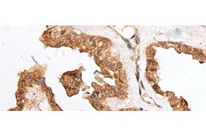 Immunohistochemistry of paraffin-embedded Human thyroid cancer tissue using HOXB9 Polyclonal Antibody at dilution of 1:45(x200)