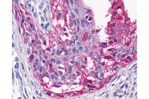 Anti-HTR4 / 5-HT4 Receptor antibody IHC of human Skin, Melanoma.