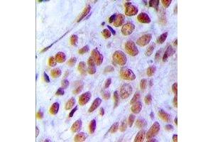 Immunohistochemical analysis of MRE11 staining in human breast cancer formalin fixed paraffin embedded tissue section. (Mre11 anticorps)