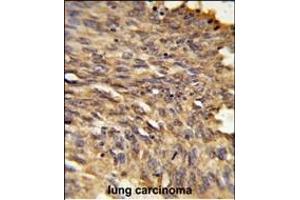 Formalin-fixed and paraffin-embedded human lung carcinoma reacted with HDLBP Antibody (Center), which was peroxidase-conjugated to the secondary antibody, followed by DAB staining. (HDLBP anticorps  (AA 764-791))