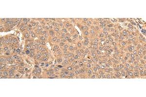 Immunohistochemistry of paraffin-embedded Human liver cancer tissue using BUD31 Polyclonal Antibody at dilution of 1:75(x200) (BUD31 anticorps)