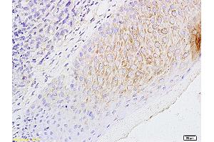 Formalin-fixed and paraffin embedded mouse foot tumor labeled with Anti-CCL21/6CKINE Polyclonal Antibody, Unconjugated (ABIN732698) followed by conjugation to the secondary antibody and DAB staining (CCL21 anticorps  (AA 24-134))