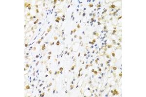 Immunohistochemistry of paraffin-embedded human kidney cancer using SUMO4 Antibody.