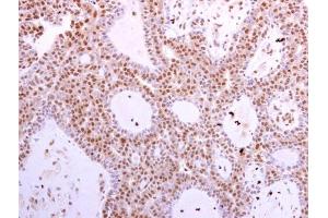 CDK6 antibody [N1C3] detects CDK6 protein at cytoplasm and nucleus in human lung adenocarcinoma by immunohistochemical analysis.