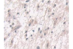 Detection of FUT6 in Human Glioma Tissue using Polyclonal Antibody to Fucosyltransferase 6 (FUT6)