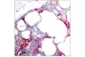 Immunohistochemical analysis of paraffin-embedded human breast carcinoma tissue using ATF2(Phospho-Ser62 or 44) Antibody. (ATF2 anticorps  (pSer62))