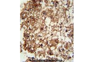 CD11b antibody (N-term) immunohistochemistry analysis in formalin fixed and paraffin embedded human hepatocarcinoma followed by peroxidase conjugation of the secondary antibody and DAB staining. (CD11b anticorps  (N-Term))