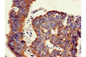 Immunohistochemistry of paraffin-embedded human colon cancer using ABIN7145493 at dilution of 1:100